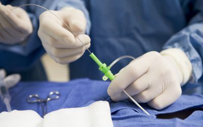 Contra la trombosis, ¿catéter o anticoagulantes?