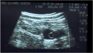 a doppler ultrasound scan showing a blood clot