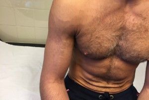torso de un hombre con una tormbosis en el brazo