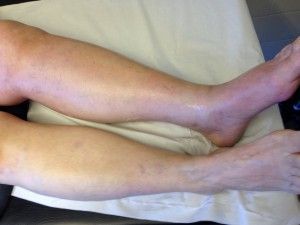 legs of a person with venous thrombosis