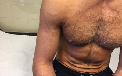 Thrombosis in the arm that doesn’t need hospital admission