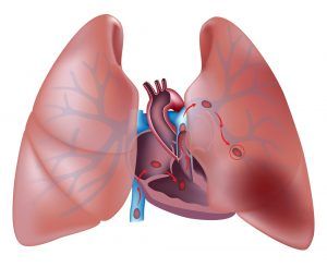 tromboinfo-pulmonaryembolism