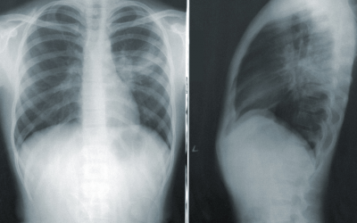 Detectar a tiempo una embolia pulmonar en los enfermos con COVID-19 puede mejorar su recuperación