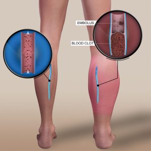 illustration of a deep vein thrombosis