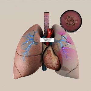 illustration of a pulmonary embolism