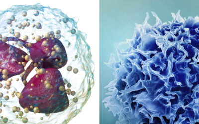 Un nuevo marcador sanguíneo mejora el pronóstico en la embolia pulmonar